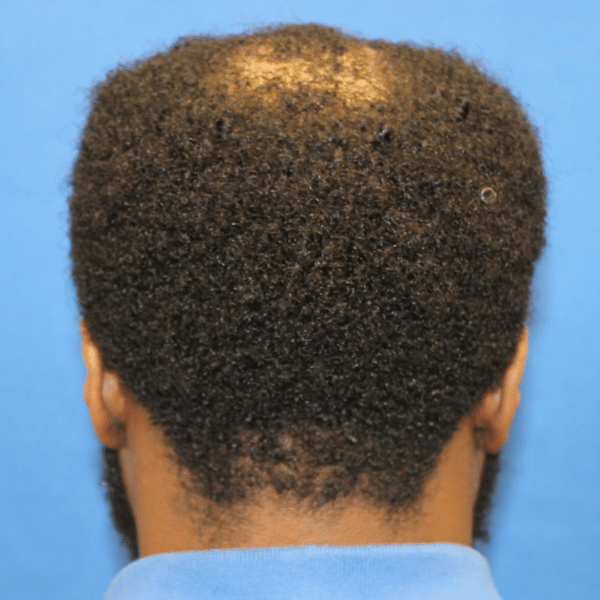 Hair Transplant