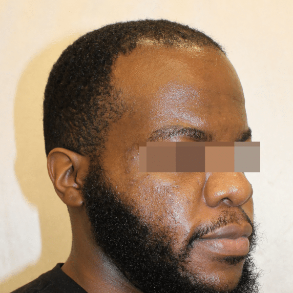 Hair Transplant