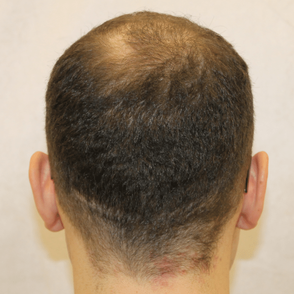 Hair Transplant