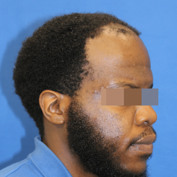 Hair Transplant