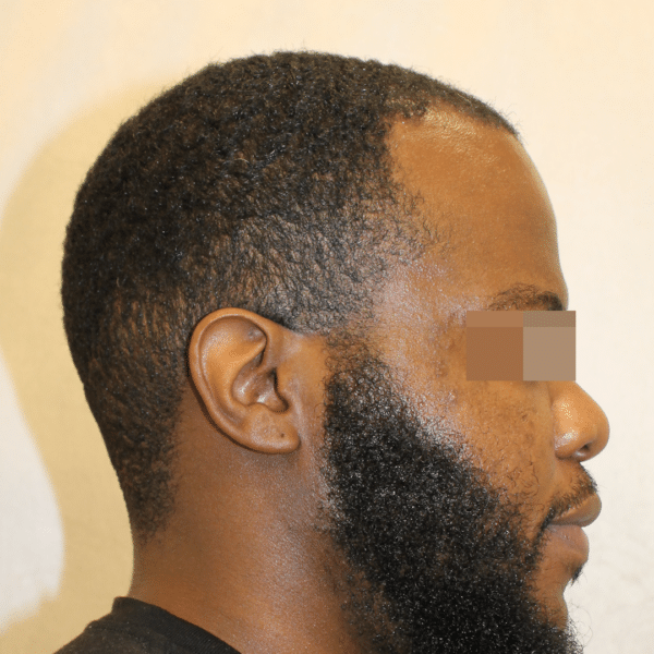 Hair Transplant