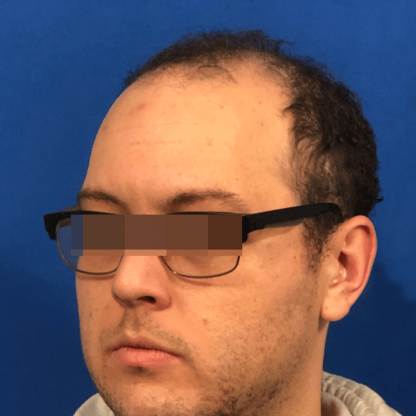 Hair Transplant