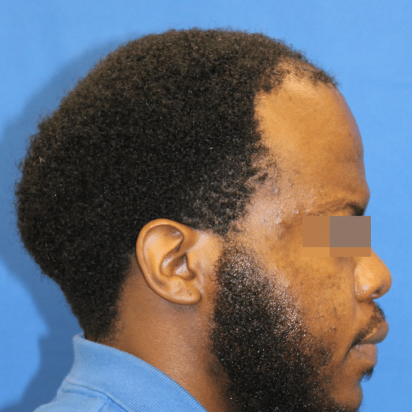 Hair Transplant