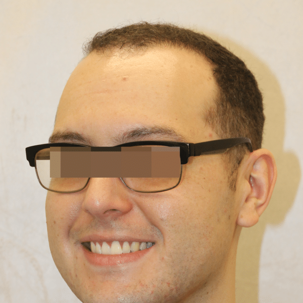 Hair Transplant