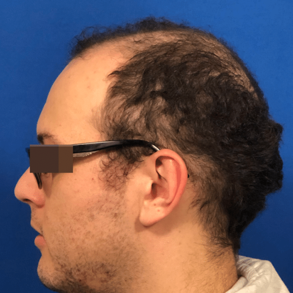 Hair Transplant