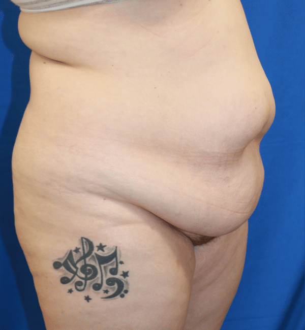 Body Procedures