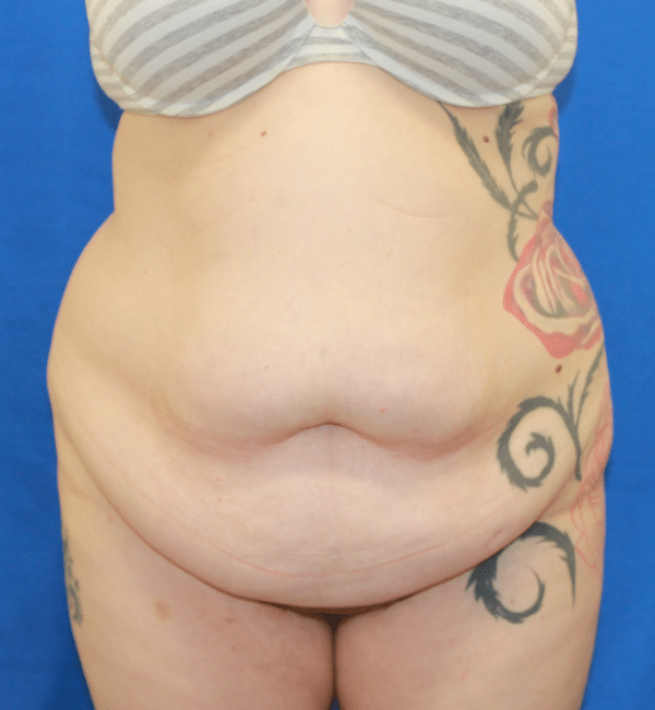 Body Procedures
