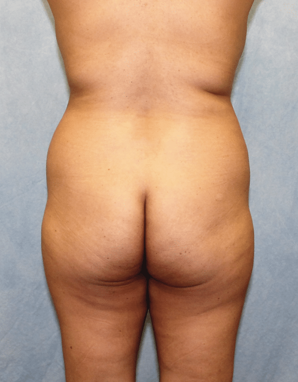 Brazilian Butt Lift