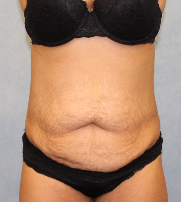 Abdominoplasty - Tummy Tuck