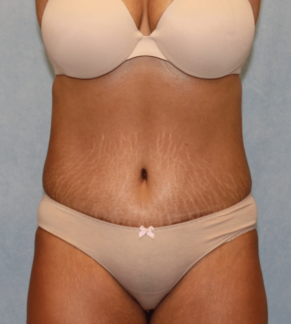 Abdominoplasty - Tummy Tuck
