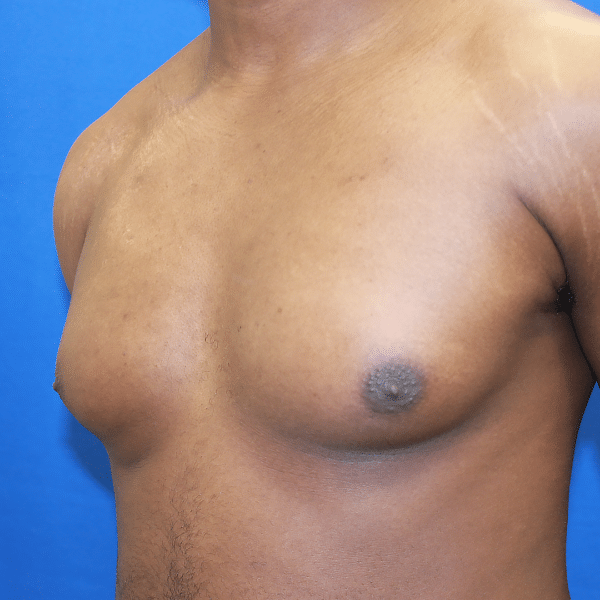 Male Breast Reduction