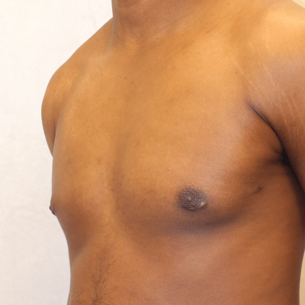 Male Breast Reduction