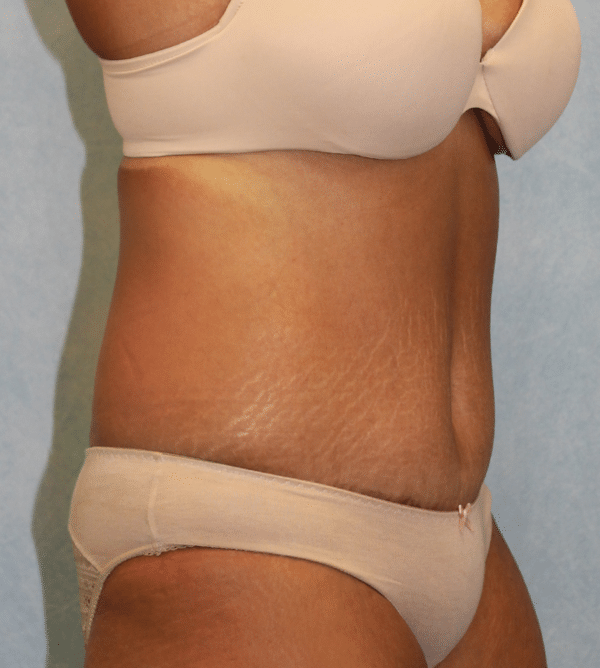 Abdominoplasty - Tummy Tuck
