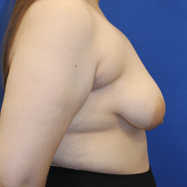 Breast Lift with Implants
