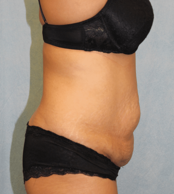 Abdominoplasty - Tummy Tuck
