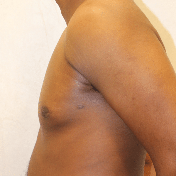 Male Breast Reduction