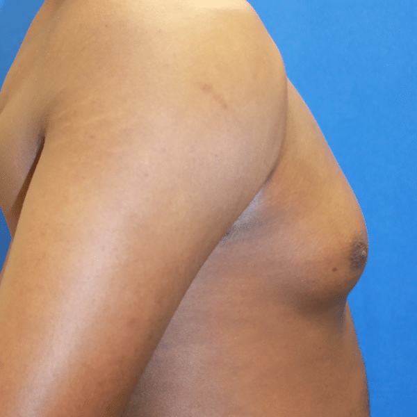 Male Breast Reduction