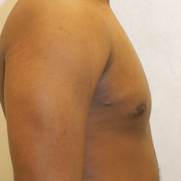 Male Breast Reduction