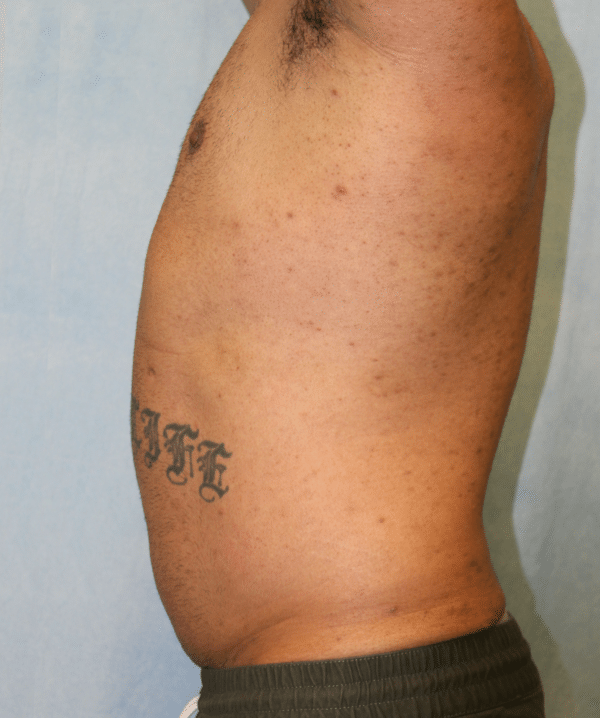 Liposuction
