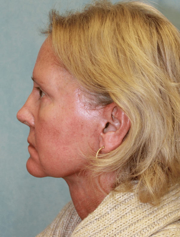 Facelift
