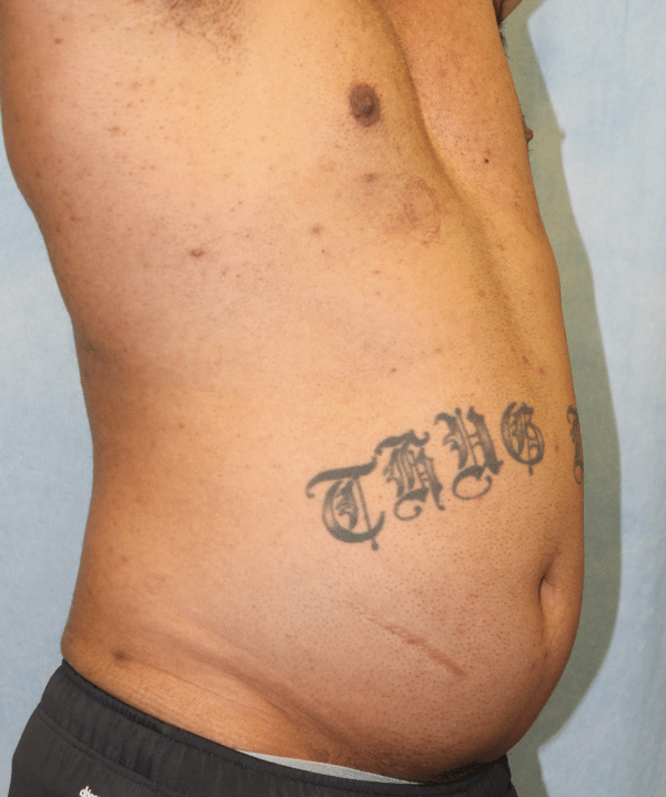 Liposuction