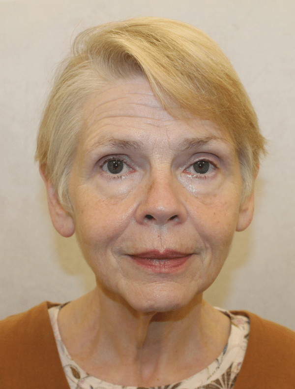 Facelift