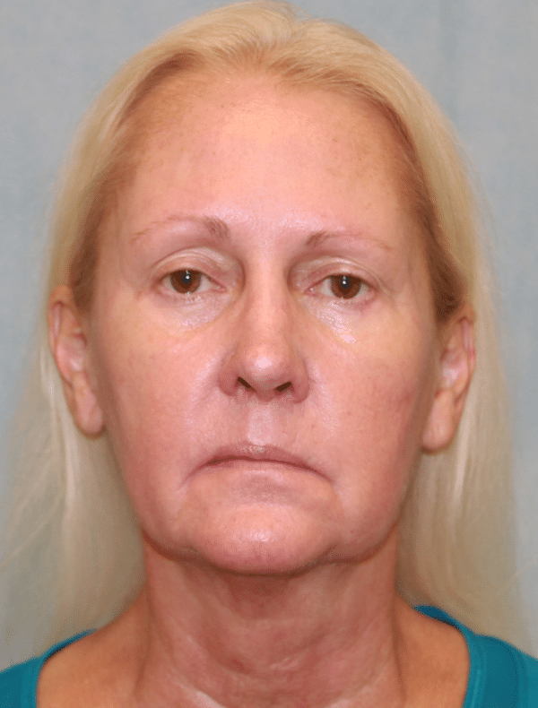 Facelift
