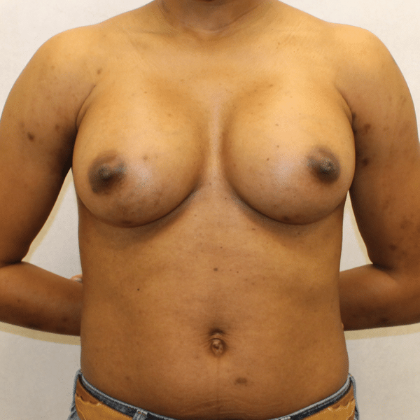 Breast Augmentation