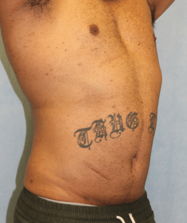 Liposuction