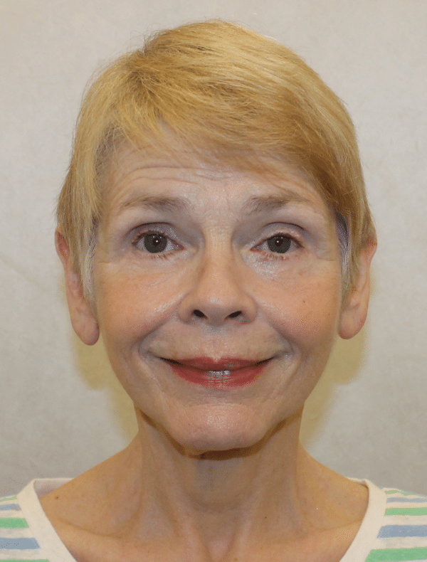 Facelift