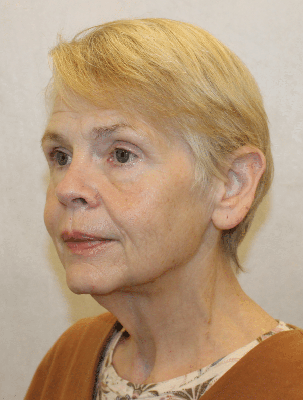 Facelift