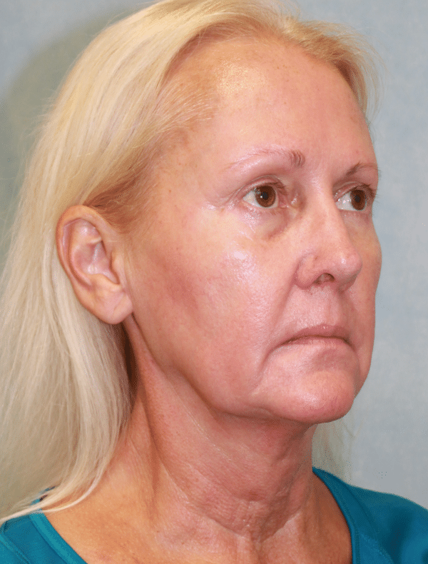 Facelift