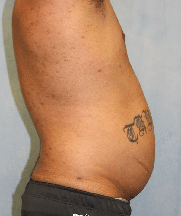 Liposuction