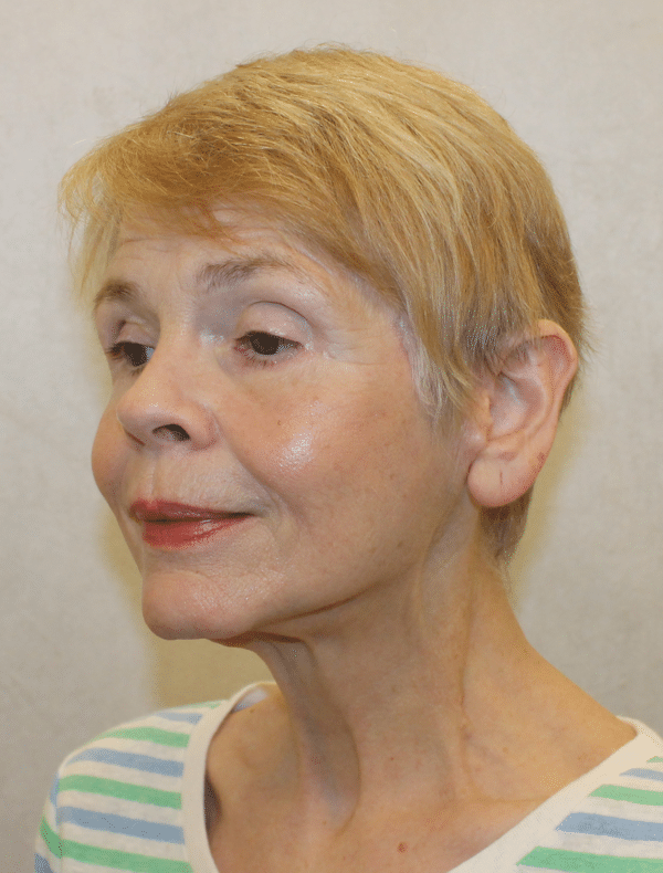 Facelift