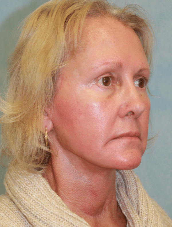 Facelift