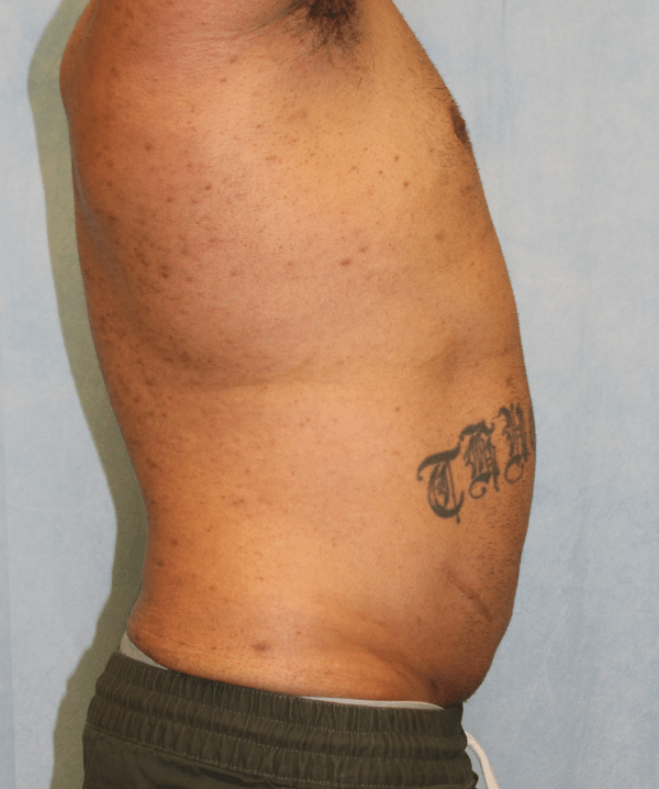 Liposuction