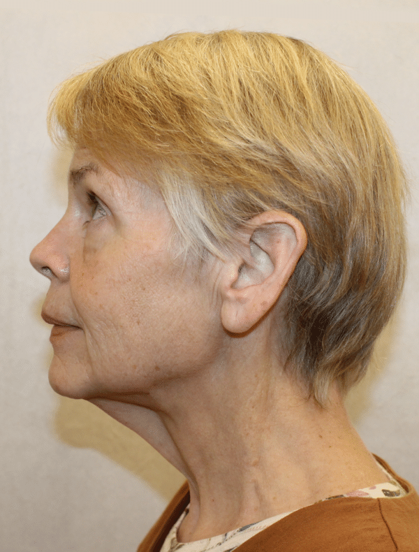 Facelift