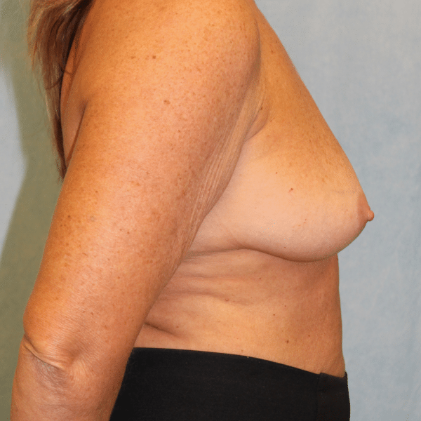 Breast Lift with Implants