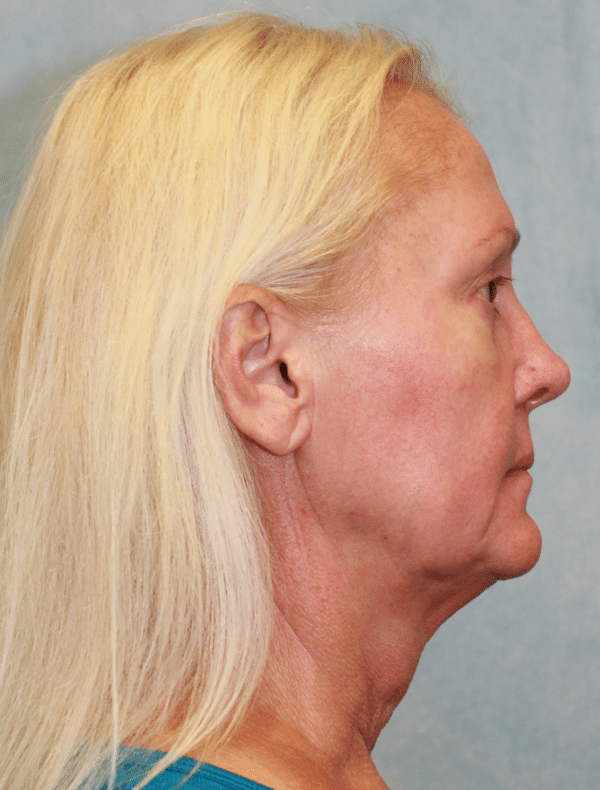 Facelift