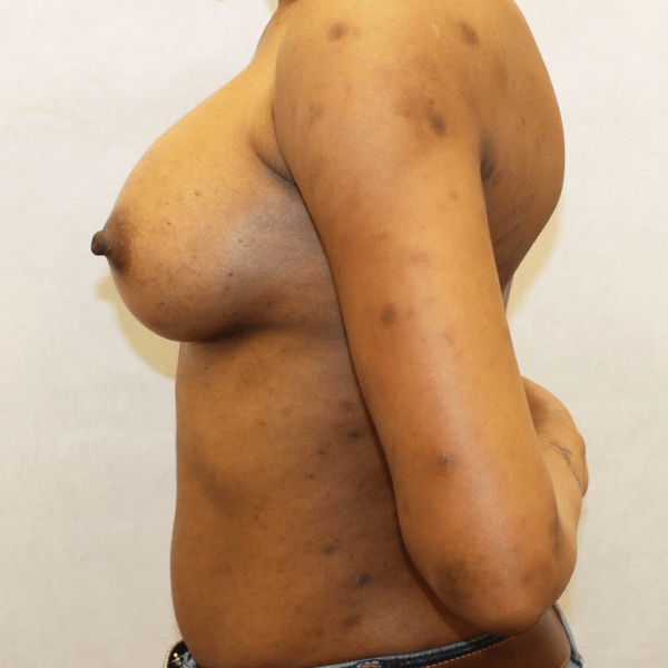 Breast Augmentation