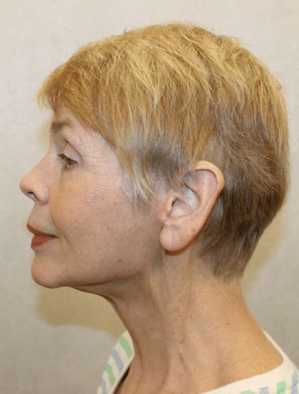 Facelift