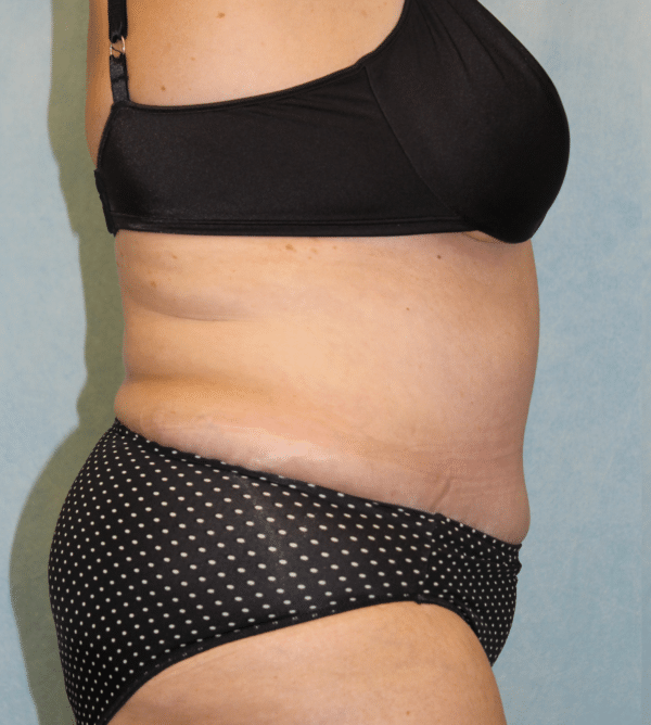 Abdominoplasty - Tummy Tuck