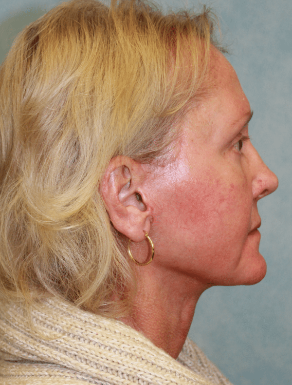 Facelift