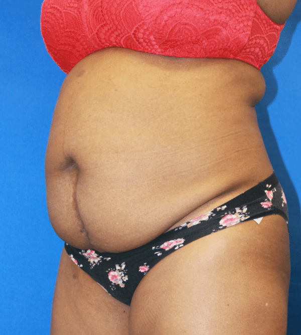 Abdominoplasty - Tummy Tuck