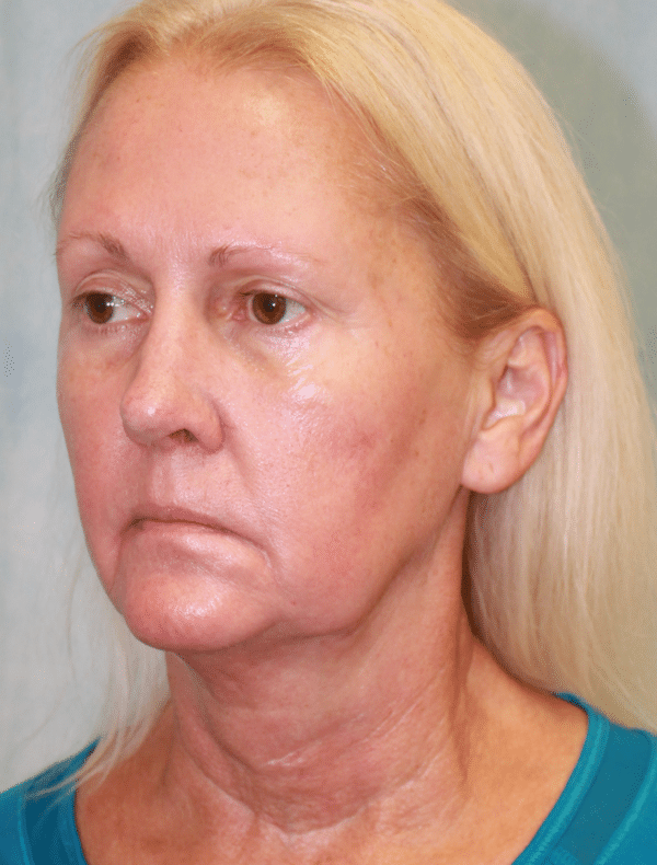 Facelift