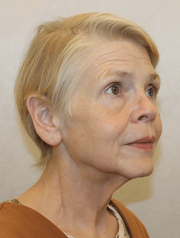 Facelift