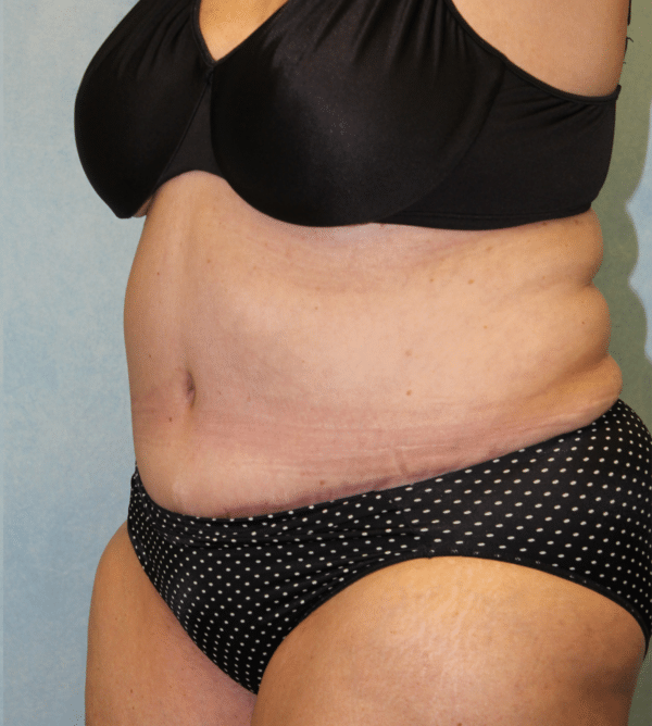 Abdominoplasty - Tummy Tuck