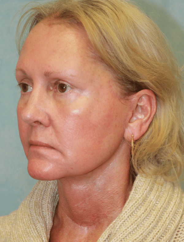 Facelift