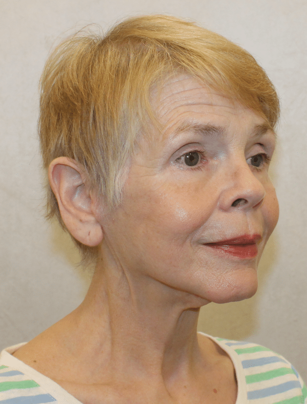 Facelift