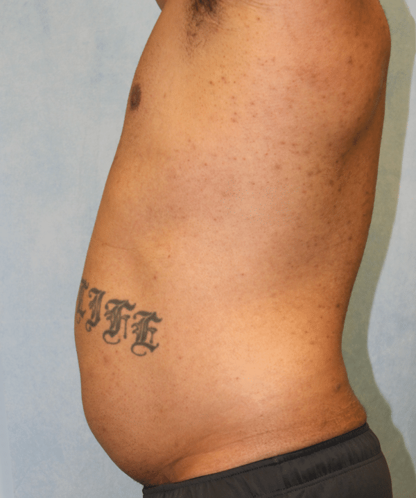 Liposuction